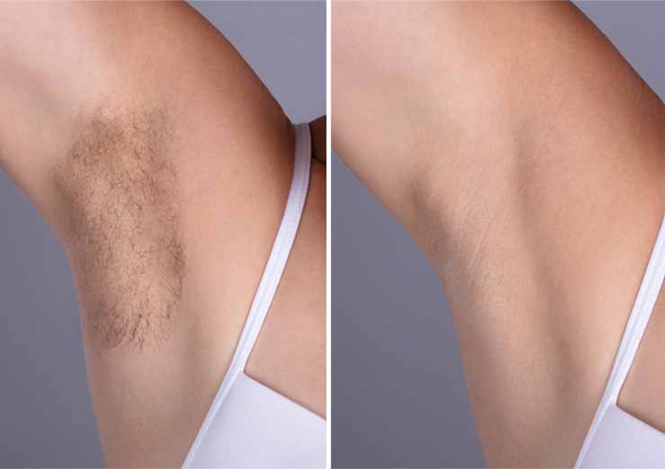 laser-hair-removal-rickmansworth