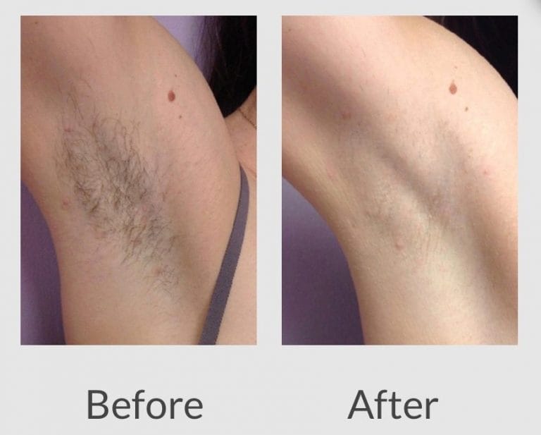 Laser Hair Removal - Rickmansworth - KaiJa Wellness & Beauty Therapy