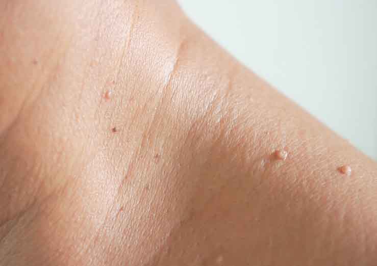 Skin Tag Removal Rickmansworth Kaija Wellness And Beauty Therapy